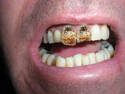 rust teeth 