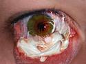  Eye Tumor